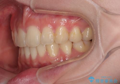 深い咬み合わせと飛び出した前歯　ワイヤー装置での抜歯矯正治療の治療後