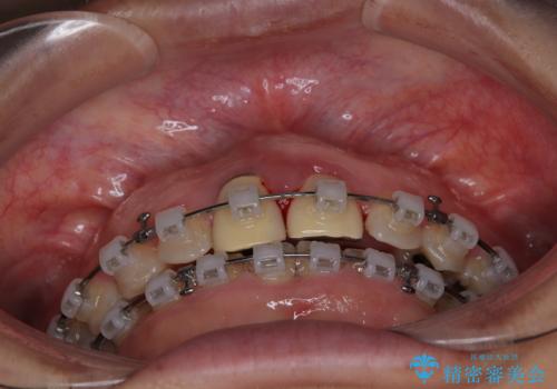 前歯のデコボコをワイヤー矯正で綺麗に 保険診療の前歯クラウンもセラミッククラウンで自然にの治療中