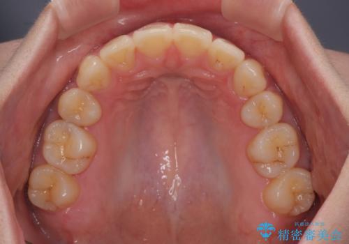 深い咬み合わせと飛び出した前歯　ワイヤー装置での抜歯矯正治療の治療後