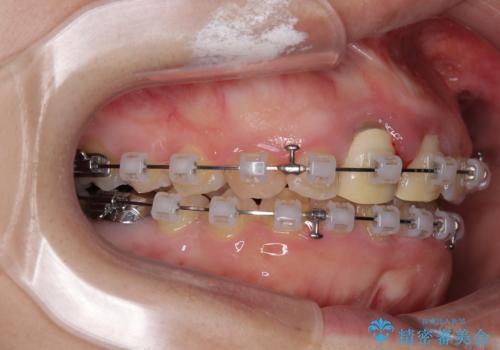 前歯のデコボコをワイヤー矯正で綺麗に　保険診療の前歯クラウンもセラミッククラウンで自然にの治療中