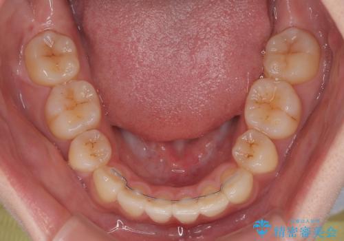 深い咬み合わせと飛び出した前歯 ワイヤー装置での抜歯矯正治療の治療後