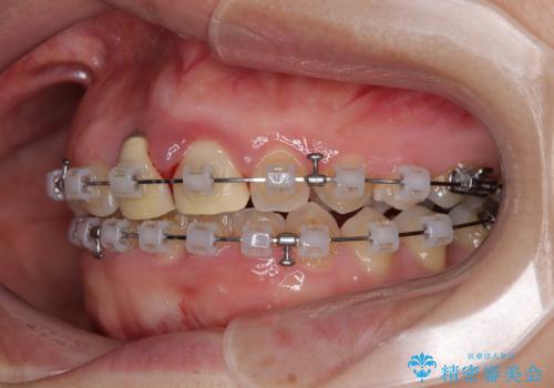 前歯のデコボコをワイヤー矯正で綺麗に　保険診療の前歯クラウンもセラミッククラウンで自然にの治療中