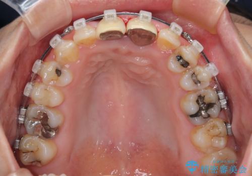 前歯のデコボコをワイヤー矯正で綺麗に　保険診療の前歯クラウンもセラミッククラウンで自然にの治療中