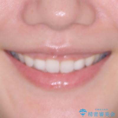 前歯のデコボコと小さい歯を改善 インビザラインとオールセラミッククラウンの治療後(顔貌)