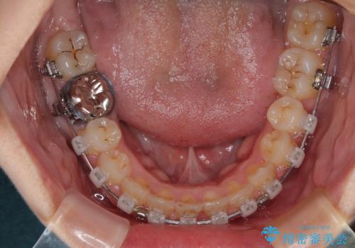 前歯のデコボコをワイヤー矯正で綺麗に 保険診療の前歯クラウンもセラミッククラウンで自然にの治療中