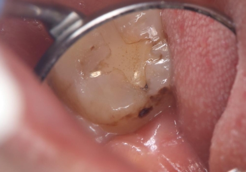 【セラミックインレー】歯の奥側に虫歯ができてしまった