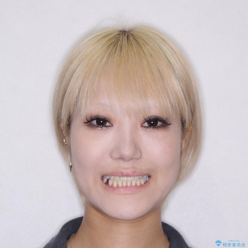 【モニター】前歯のデコボコをインビザラインで綺麗にの治療後(顔貌)