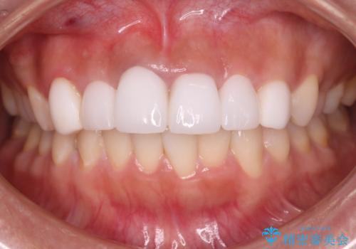 【オールセラミッククラウン】歯の色を合わせたいの治療後