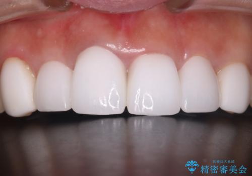 【オールセラミッククラウン】歯の色を合わせたいの治療後