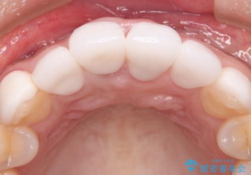 【オールセラミッククラウン】歯の色を合わせたいの治療後