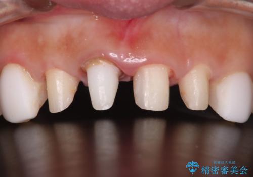 【オールセラミッククラウン】歯の色を合わせたいの治療中