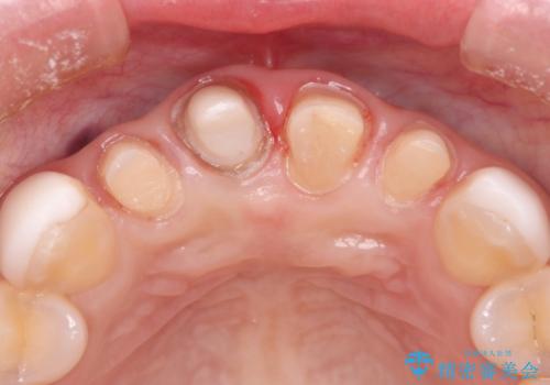 【オールセラミッククラウン】歯の色を合わせたいの治療中