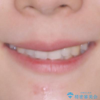 前歯が隠れるほどのデコボコをインビザライン矯正できれいに整えるの治療後(顔貌)