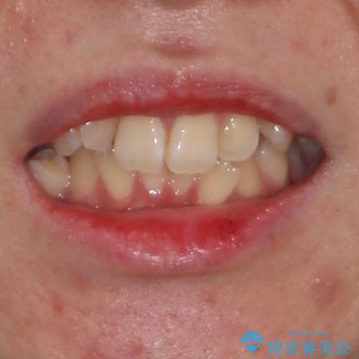 デコボコだらけの歯列をきれいに ワイヤー装置での抜歯矯正治療の治療前(顔貌)