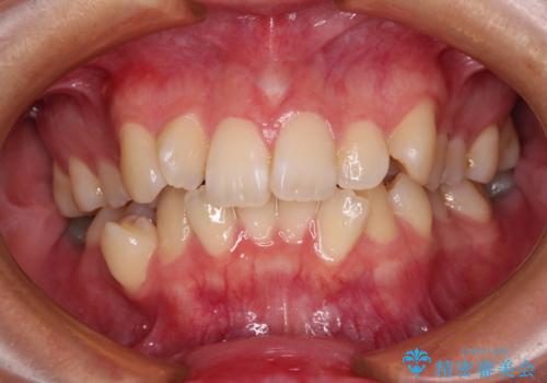 デコボコだらけの歯列をきれいに　ワイヤー装置での抜歯矯正治療の症例 治療前