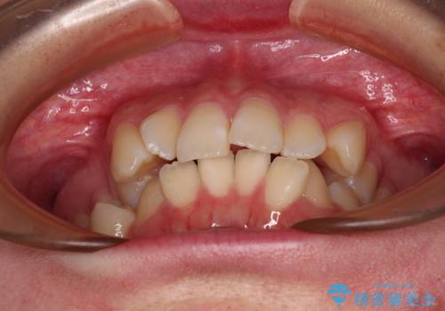 デコボコだらけの歯列をきれいに　ワイヤー装置での抜歯矯正治療の治療前