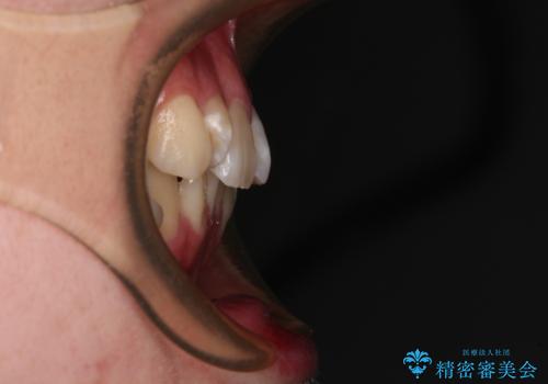 デコボコだらけの歯列をきれいに ワイヤー装置での抜歯矯正治療の治療前