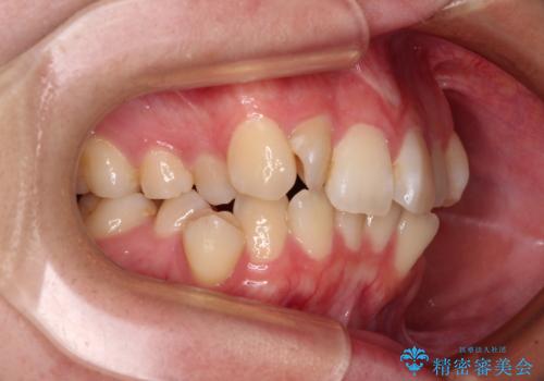 デコボコだらけの歯列をきれいに　ワイヤー装置での抜歯矯正治療の治療前