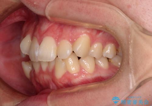 デコボコだらけの歯列をきれいに ワイヤー装置での抜歯矯正治療の治療前