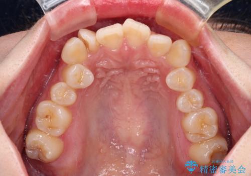 デコボコだらけの歯列をきれいに ワイヤー装置での抜歯矯正治療の治療前