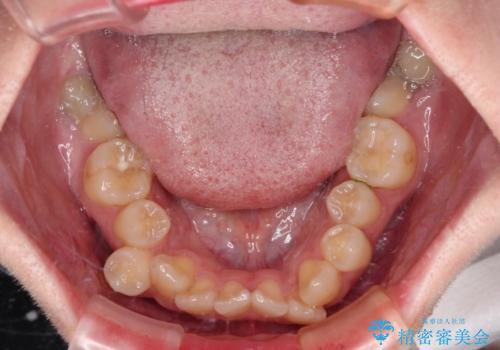 デコボコだらけの歯列をきれいに　ワイヤー装置での抜歯矯正治療の治療前