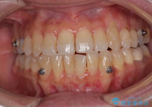 受け口と八重歯を改善　インビザライン矯正治療の治療中