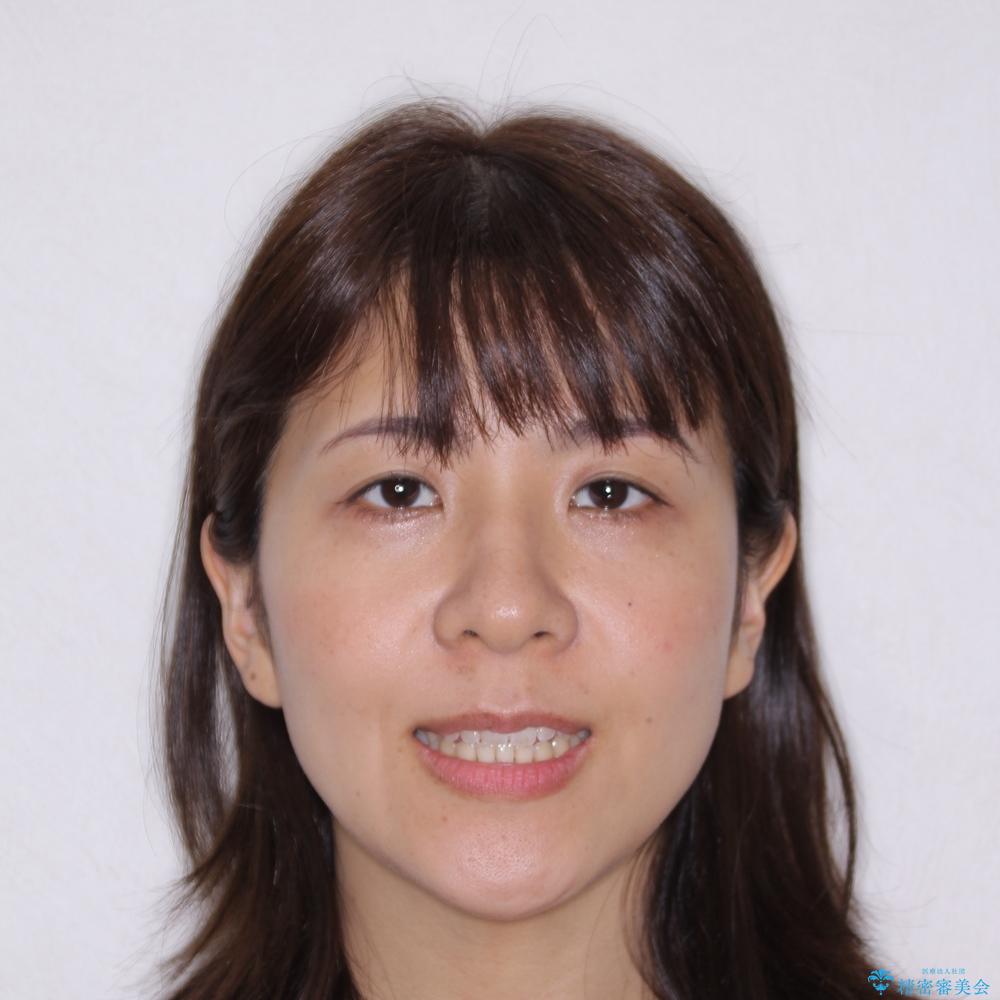 【モニター】食事が取りづらい 極端な開咬をインビザラインで解決の治療後(顔貌)