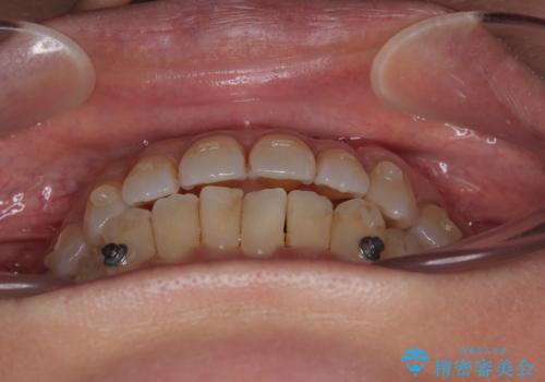 受け口と八重歯を改善 インビザライン矯正治療の治療中