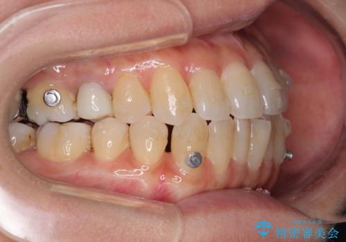 受け口と八重歯を改善 インビザライン矯正治療の治療中
