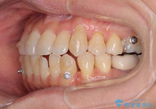 受け口と八重歯を改善 インビザライン矯正治療の治療中