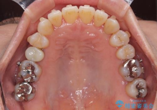 受け口と八重歯を改善 インビザライン矯正治療の治療中