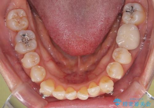 受け口と八重歯を改善　インビザライン矯正治療の治療中