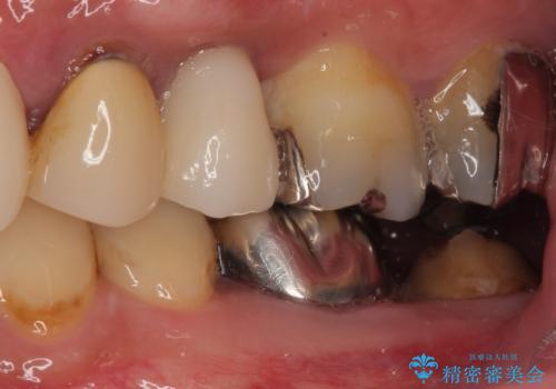 外科処置は1回のみ|抜歯即時インプラントで小臼歯を短期間で機能・審美回復した症例の治療後