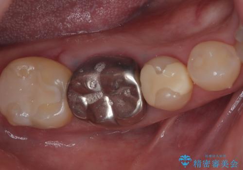 銀の詰め物を白くしたいの症例 治療後