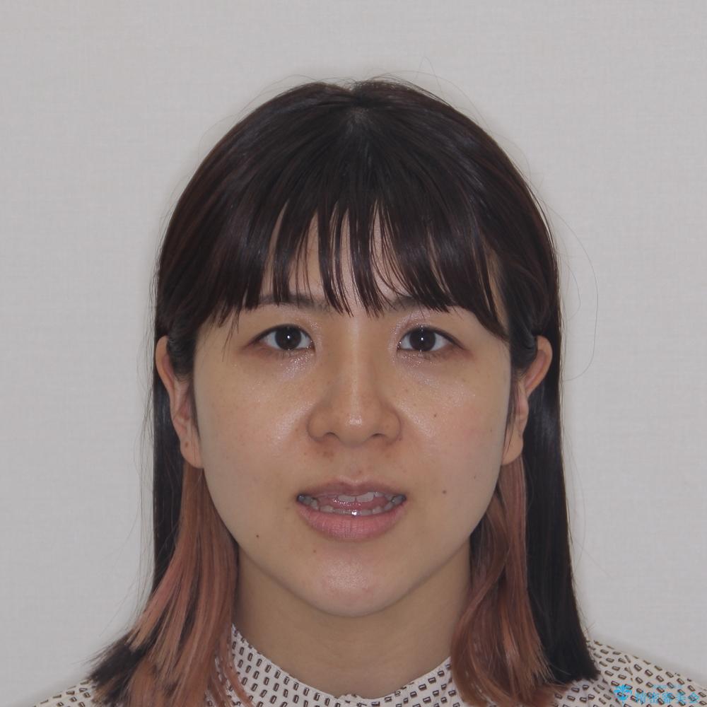 【モニター】食事が取りづらい 極端な開咬をインビザラインで解決の治療前(顔貌)