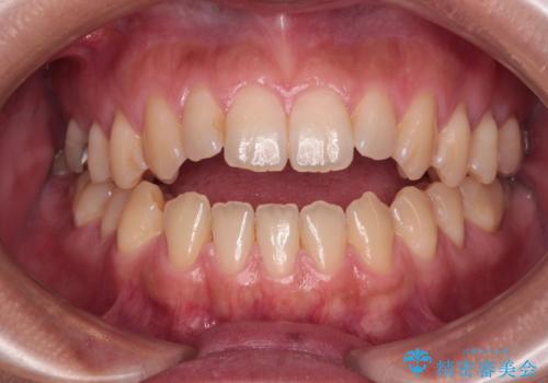 【モニター】食事が取りづらい　極端な開咬をインビザラインで解決の症例 治療前