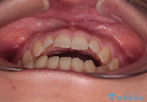 【モニター】食事が取りづらい　極端な開咬をインビザラインで解決の治療前