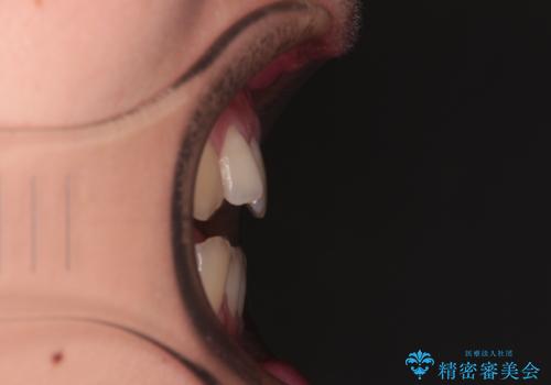 【モニター】食事が取りづらい 極端な開咬をインビザラインで解決の治療前