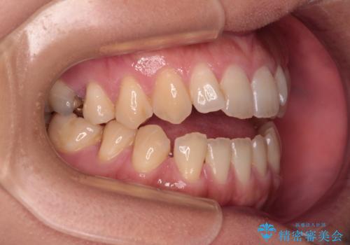 【モニター】食事が取りづらい 極端な開咬をインビザラインで解決の治療前