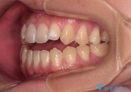 【モニター】食事が取りづらい 極端な開咬をインビザラインで解決の治療前