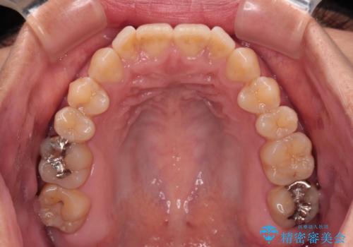 【モニター】食事が取りづらい　極端な開咬をインビザラインで解決の治療前