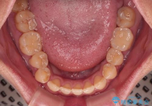 【モニター】食事が取りづらい 極端な開咬をインビザラインで解決の治療前