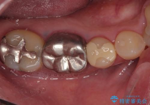 銀の詰め物を白くしたいの症例 治療前