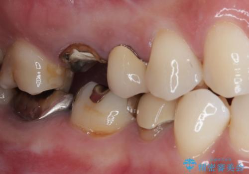 割れてしまった奥歯 1DAYインプラント治療の治療前