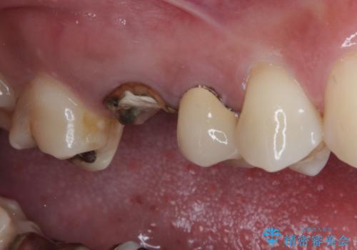 割れてしまった奥歯　1DAYインプラント治療の治療前