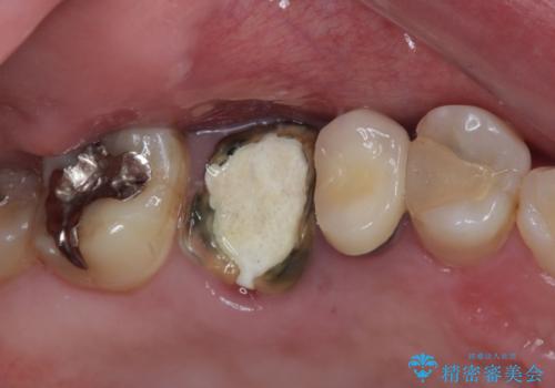 割れてしまった奥歯　1DAYインプラント治療の治療前