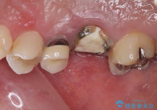 割れてしまった奥歯 1DAYインプラント治療の治療前