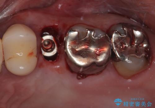 外科処置は1回のみ|抜歯即時インプラントで小臼歯を短期間で機能・審美回復した症例の治療中