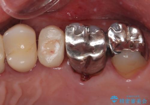 外科処置は1回のみ|抜歯即時インプラントで小臼歯を短期間で機能・審美回復した症例の治療後
