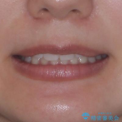 デコボコと咬み合わせを改善 インビザライン矯正治療の治療前(顔貌)